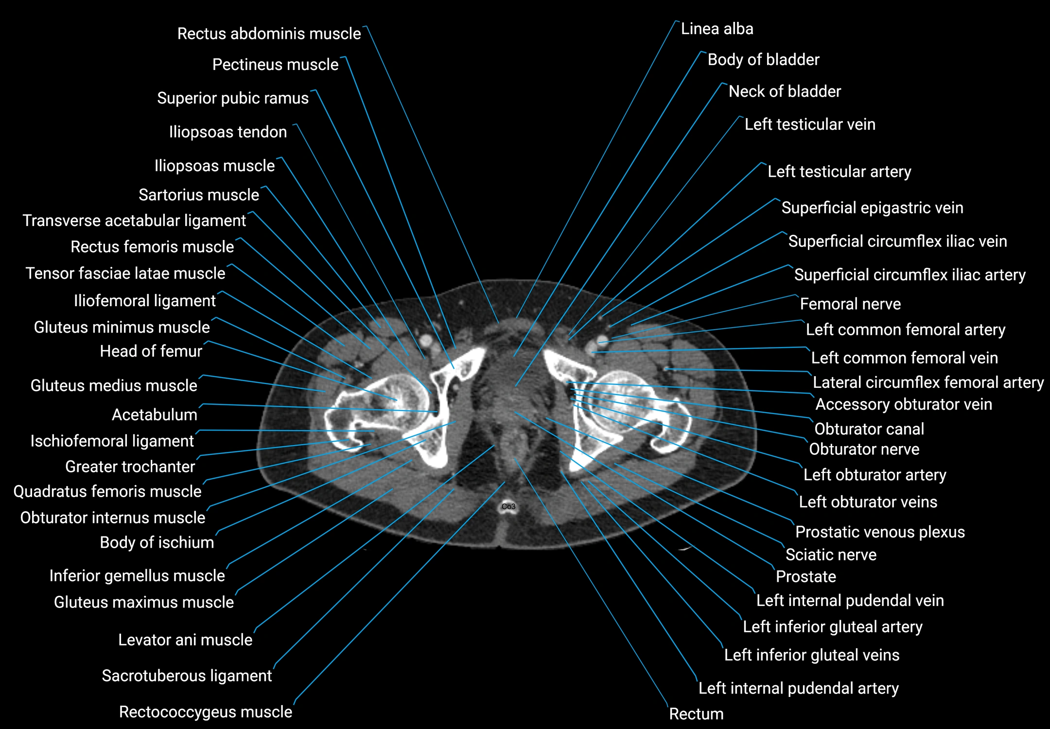 CT male pelvis axial cross sectional anatomy labelled radiology image -00193.webp